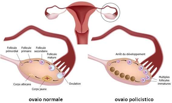 Gludia - Ovaio policistico - EIDON salus